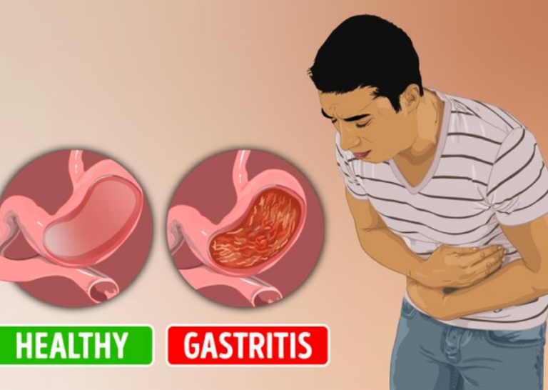 Gastritis