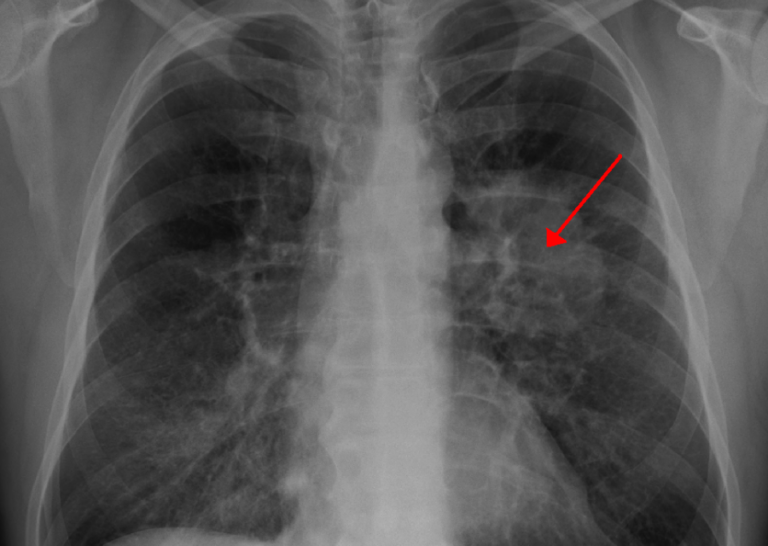 Lung cancer