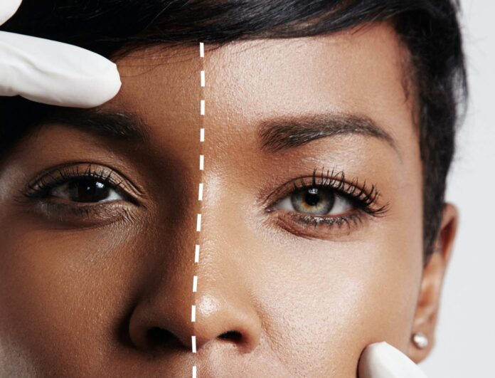 skin bleaching