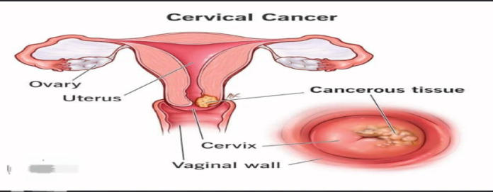 Cervical Canser