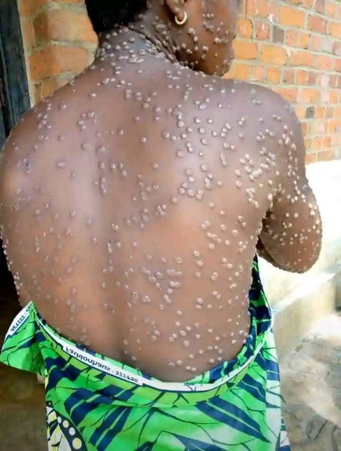 Mpox